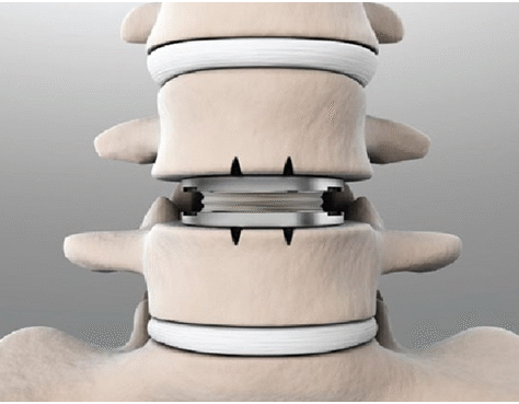 3D model of two spinal vertebrae with an artificial disc implant.